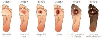 Wajib Tahu! Tak Ada Istilah Penyakit Gula Basah dan Kering dalam Dunia Medis Wajib Tahu! Tak Ada Istilah Penyakit Gula Basah dan Kering dalam Dunia Medis
