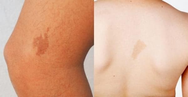 Tanda Lahir Merah Ditubuh Ternyata Mampu Ungkap Karaktermu Tanda Lahir Merah Ditubuh Ternyata Mampu Ungkap Karaktermu