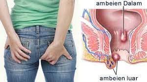 Mudah dan Aman! Cara Praktis Menghilangkan Benjolan Ambeien, Cukup Pakai Es Batu Mudah dan Aman! Cara Praktis Menghilangkan Benjolan Ambeien, Cukup Pakai Es Batu