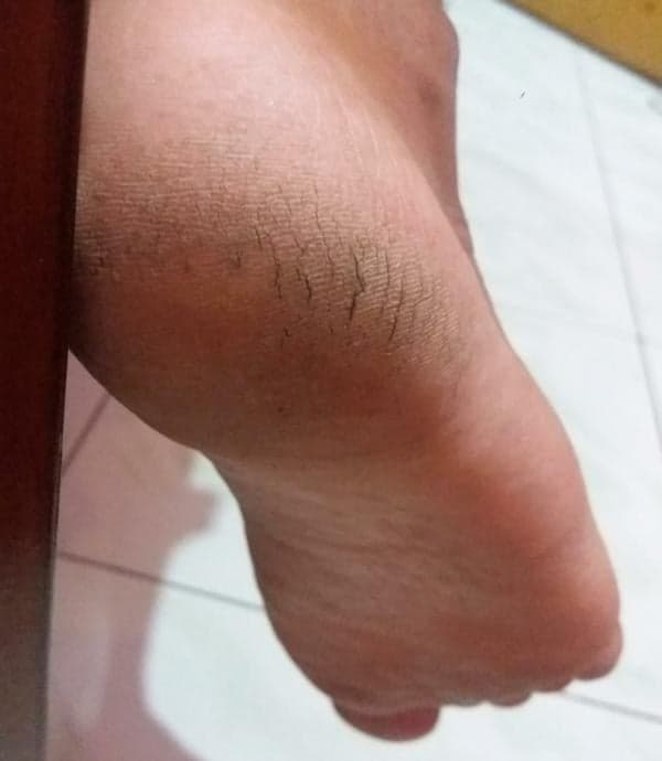 Telapak Kaki Retak dan Menghitam, Gunakan 1 Bahan Pemanis Ini. Begini caranya! Telapak Kaki Retak dan Menghitam, Gunakan 1 Bahan Pemanis Ini. Begini caranya!