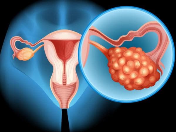 Penyebab Kanker Ovarium: Memahami Risiko dan Faktor