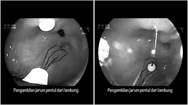 Viral, Proses Menegangkan saat Dokter Keluarkan Jarum Pentul yang Tertancap di Lambung