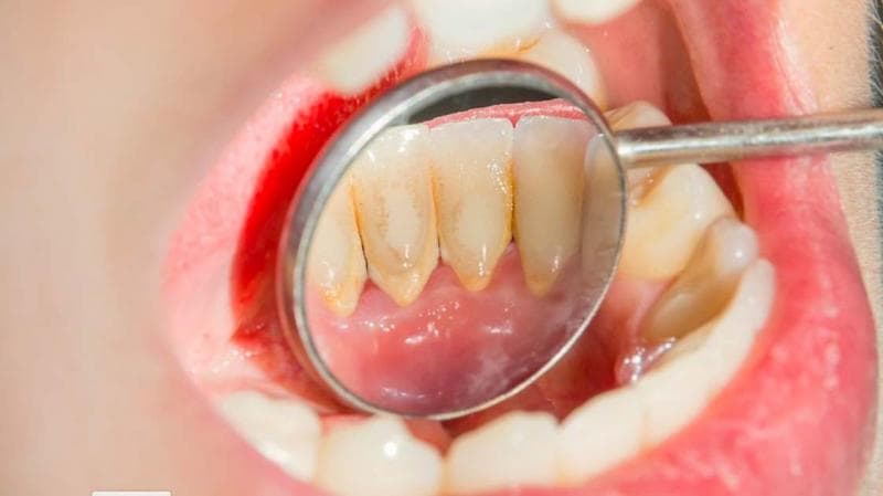 Ini 11 Cara Menghilangkan Karang Gigi yang Mengeras Secara Alami, Bisa Pakai Daun Sirih Ini 11 Cara Menghilangkan Karang Gigi yang Mengeras Secara Alami, Bisa Pakai Daun Sirih