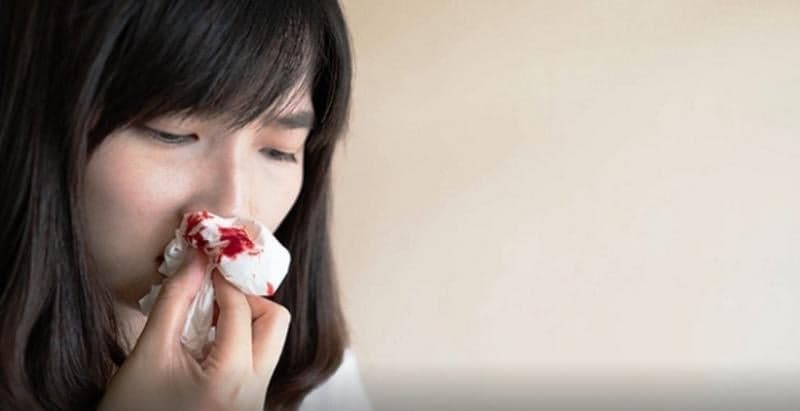 5 Arti Mimpi Mimisan, Bisa Jadi Tanda Kesehatan Memburuk 5 Arti Mimpi Mimisan, Bisa Jadi Tanda Kesehatan Memburuk