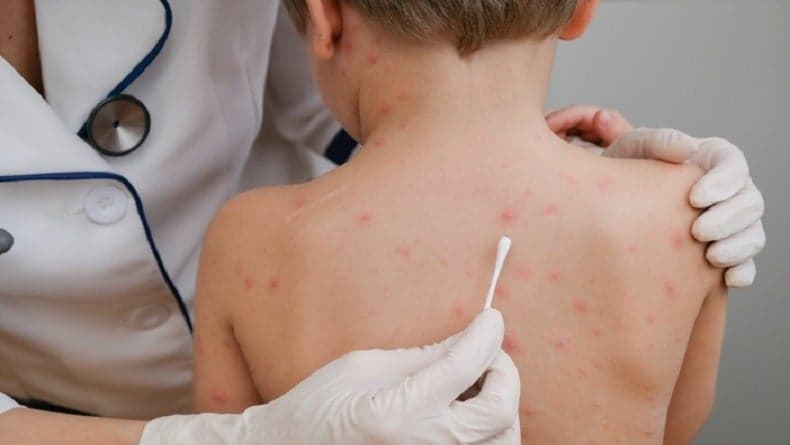 Ini 5 Cara Mengobati Cacar Air agar Cepat Kering dan Hilang Ini 5 Cara Mengobati Cacar Air agar Cepat Kering dan Hilang