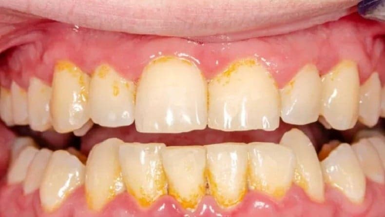 5 Cara Membersihkan Karang Gigi yang Sudah Mengeras secara Alami 5 Cara Membersihkan Karang Gigi yang Sudah Mengeras secara Alami