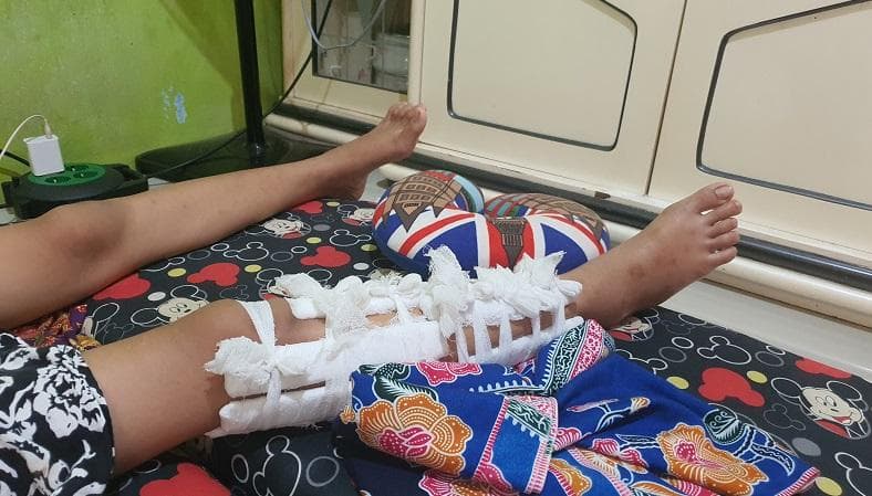 Nestapa Siswi SMP Korban Bully di Tangerang, Terbaring Lemas gegara Kaki Patah