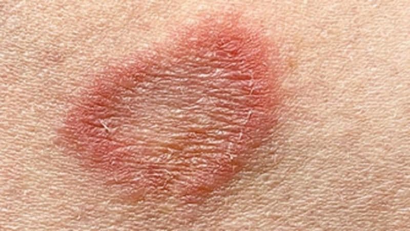 Apa Itu Ringworm? Penyakit Kulit yang Belakangan Viral di Kalangan Anak Gym Apa Itu Ringworm? Penyakit Kulit yang Belakangan Viral di Kalangan Anak Gym