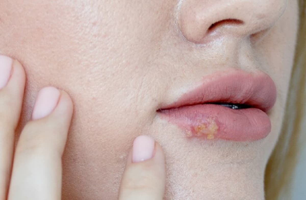 Cara Mengobati dan Mencegah Herpes, Yuk Disimak!