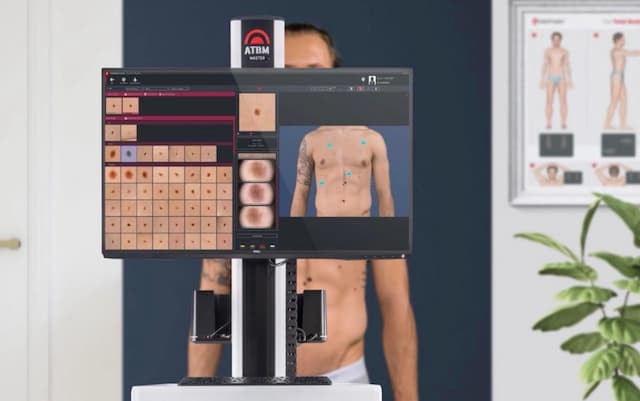 Deteksi Dini Kanker Kulit dengan TeknologiAI, Ini Kata Dokter! Deteksi Dini Kanker Kulit dengan TeknologiAI, Ini Kata Dokter!