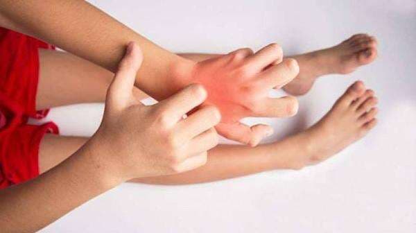 Alergi Debu Pada Kulit, Kenapa Bisa Terjadi? Alergi Debu Pada Kulit, Kenapa Bisa Terjadi?