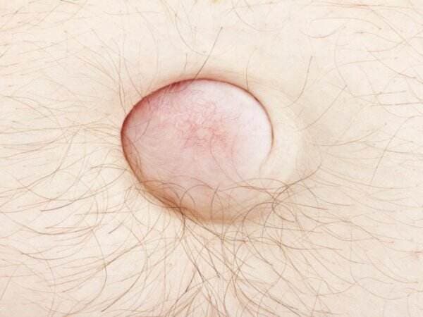 Turun Berok Itu Apa? Inilah Penyebab dan Cara Mengobatinya Turun Berok Itu Apa? Inilah Penyebab dan Cara Mengobatinya