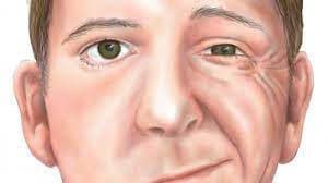 Mengenal Penyakit Bell`s Palsy yang Menyerang Wajah Mengenal Penyakit Bell`s Palsy yang Menyerang Wajah