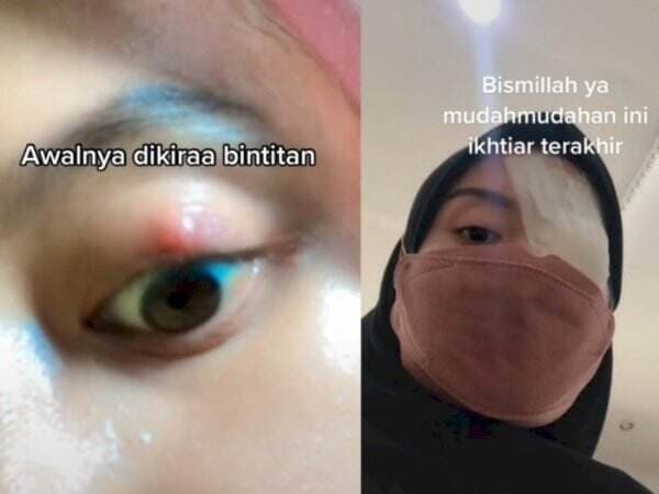 Viral Wanita Curhat Alami Benjolan di Mata, Dikira Bintitan Ternyata Kena Penyakit Ini