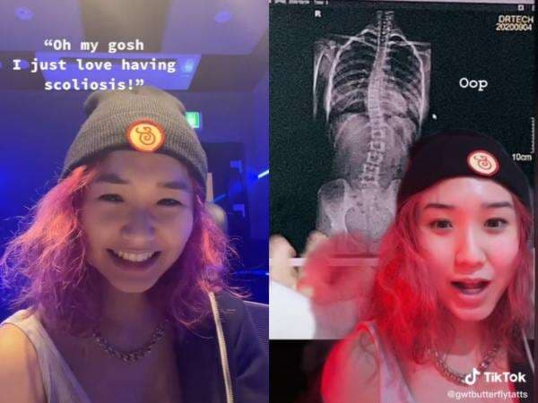 Diduga Jadi Alasan Denise Kim Hengkang dari Secret Number, Ini yang Perlu Kamu Tahu Tentang Skoliosis Diduga Jadi Alasan Denise Kim Hengkang dari Secret Number, Ini yang Perlu Kamu Tahu Tentang Skoliosis