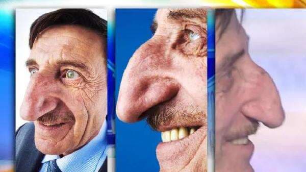 Viral Hidung Terpanjang, Pria Turki Mehmet Ozyurek: Belajar Damai dengan Kondisi Fisik Viral Hidung Terpanjang, Pria Turki Mehmet Ozyurek: Belajar Damai dengan Kondisi Fisik