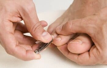 3 Cara untuk Mengobati Cantengan yang Sudah Bengkak 3 Cara untuk Mengobati Cantengan yang Sudah Bengkak