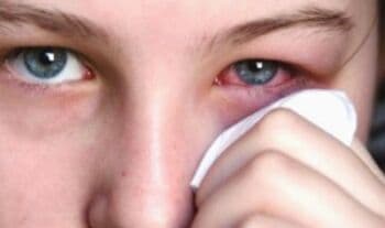 9 Cara Mengobati Mata Bintitan dengan Mudah dan Cepat 9 Cara Mengobati Mata Bintitan dengan Mudah dan Cepat