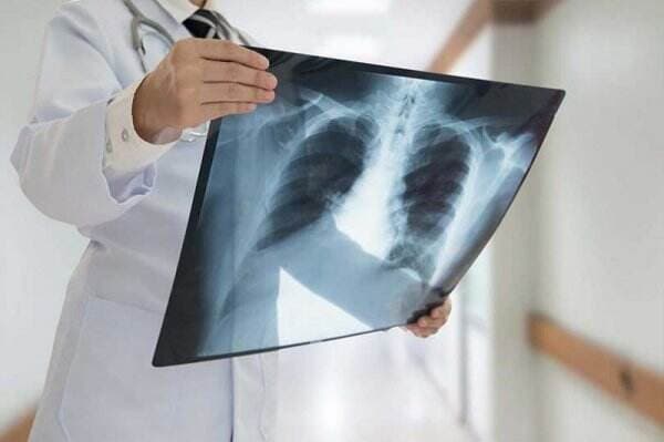 Pneumothorax, Gejala, Penyebab dan Cara Mengobati