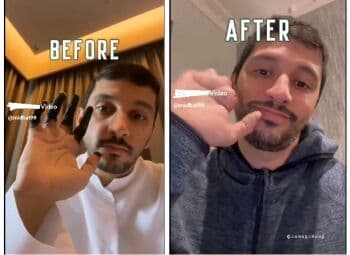 Kenali Penyakit Frostbite, yang Menyebab Seorang Pria Kehilangan Seluruh Jari Tangan Kenali Penyakit Frostbite, yang Menyebab Seorang Pria Kehilangan Seluruh Jari Tangan