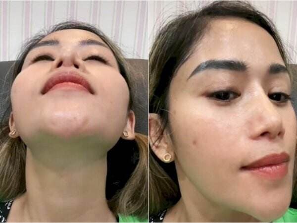 Lubang Hidung Farida Nurhan Kecil Sebelah usai Operasi, Ini Risiko Kesehatan Terkait Oplas