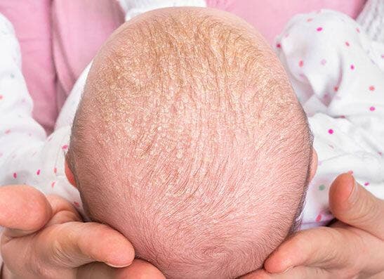Cradle Cap, Kerak Kepala Bayi dan Cara Membersihkannya Cradle Cap, Kerak Kepala Bayi dan Cara Membersihkannya