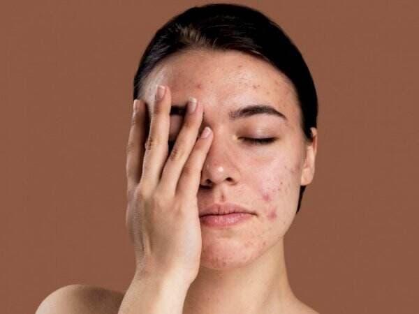 Punya Acne Scars, Begini Atasi Wajah Bopeng Akibat Bekas Jerawat Punya Acne Scars, Begini Atasi Wajah Bopeng Akibat Bekas Jerawat