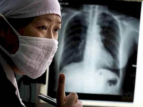 Jumlah Penderita Tuberkulosis Meningkat Tiap Tahun