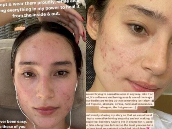 Tatjana Saphira Sengaja Tunjukkan Bare Face, Wajah Jerawatan Berani Tampil Apa Adanya