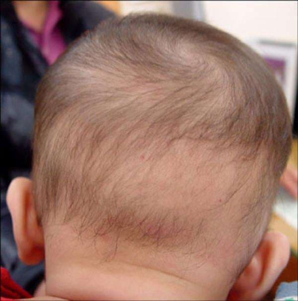 Penyakit Alopecia Areata Pada Anak, Bisa Sebabkan Botak Penyakit Alopecia Areata Pada Anak, Bisa Sebabkan Botak