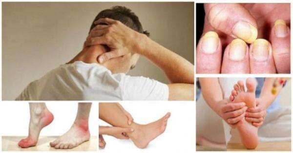 5 Gejala Kolesterol yang Bisa Terlihat Jelas dari Kulit, Begini Bentuknya 5 Gejala Kolesterol yang Bisa Terlihat Jelas dari Kulit, Begini BentuknyaÂ