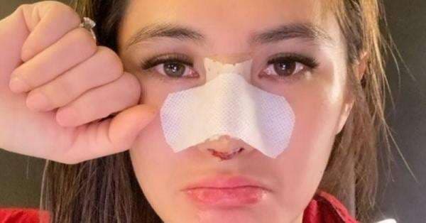 Cek Biaya Operasi Hidung Lengkap dengan Prosedurnya Cek Biaya Operasi Hidung Lengkap dengan Prosedurnya