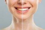 Proses dan Efek Bleaching Gigi, Memahami Pemutihan Gigi yang Aman Efektif