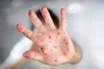 Viral Mitos Penyakit Mpox Efek dari Vaksin COVID-19, Kemenkes Tegaskan Tak Ada Hubungannya