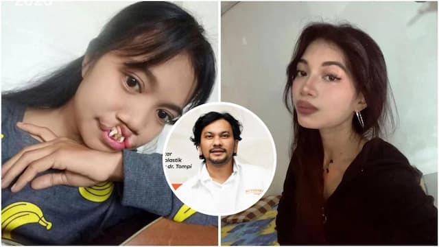 Viral Transformasi TikToker Rista, Pasien Bibir Sumbing yang Dioperasi Gratis Dokter Tompi! Viral Transformasi TikToker Rista, Pasien Bibir Sumbing yang Dioperasi Gratis Dokter Tompi!