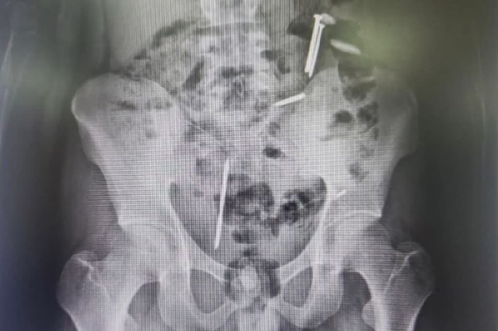 Ngeri! Paku hingga Koin Ditemukan dalam Tubuh Remaja asal Jember, kok Bisa? Ngeri! Paku hingga Koin Ditemukan dalam Tubuh Remaja asal Jember, kok Bisa?