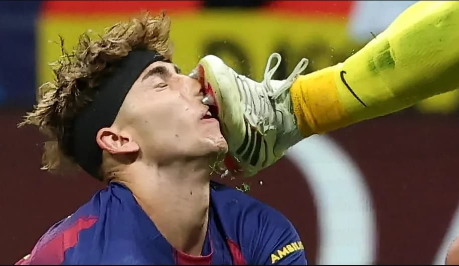 Horor! Fermin Lopez Berdarah-Darah Usai Kena Tendangan Kiper Atletico Horor! Fermin Lopez Berdarah-Darah Usai Kena Tendangan Kiper Atletico