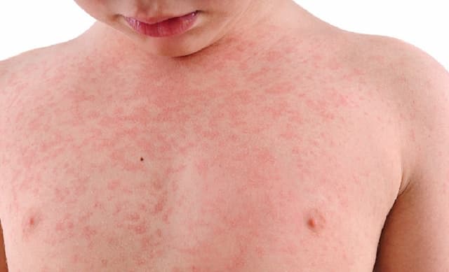 4 Cara Mencegah Penularan Campak pada Anak, Moms Wajib Tau! 4 Cara Mencegah Penularan Campak pada Anak, Moms Wajib Tau!