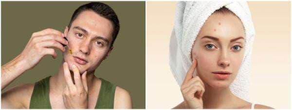 9 Serum lokal untuk kulit berjerawat, harga terjangkau 9 Serum lokal untuk kulit berjerawat, harga terjangkau