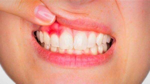 3 Cara Mengobati Gusi Bengkak, Bisa Pakai Lidah Buaya hingga Air Garam 3 Cara Mengobati Gusi Bengkak, Bisa Pakai Lidah Buaya hingga Air Garam