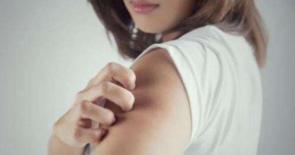 Simak 5 Tips Berikut Ini untuk Mengobati Biduran Simak 5 Tips Berikut Ini untuk Mengobati Biduran