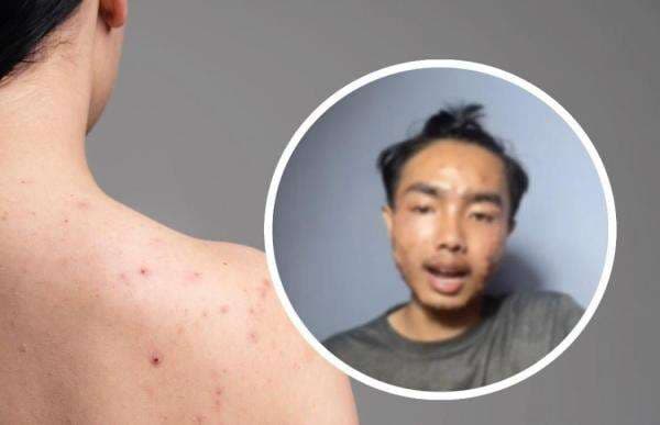 Cek Fakta! gegara Baju Thrifting Pria Ini Kena Penyakit Kulit Mengerikan Cek Fakta! gegara Baju Thrifting Pria Ini Kena Penyakit Kulit Mengerikan