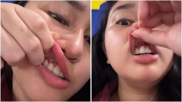 Penyebab Kista di Gigi seperti Dialami Denise Chariesta, Benarkah Sering Infeksi? Penyebab Kista di Gigi seperti Dialami Denise Chariesta, Benarkah Sering Infeksi?