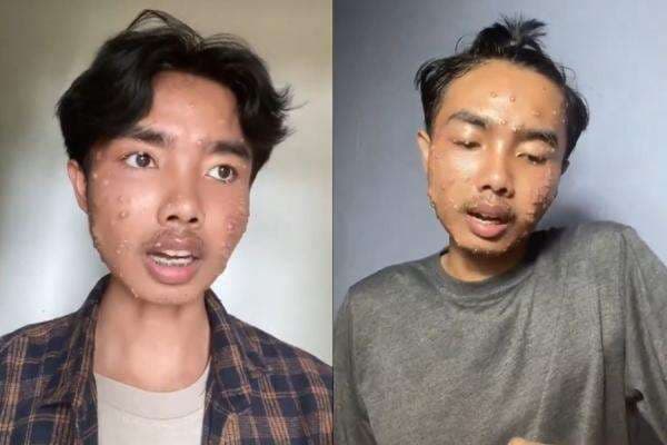 Mengenal Moluskum Kontagiosum, Penyakit Kulit Akibat Pakai Baju Thrifting Tanpa Dicuci Mengenal Moluskum Kontagiosum, Penyakit Kulit Akibat Pakai Baju Thrifting Tanpa Dicuci